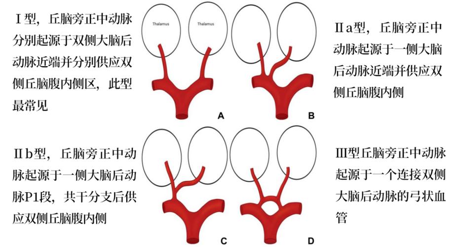 percheron动脉截图
