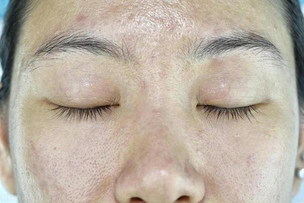 脸部暗黑发黄怎么改善