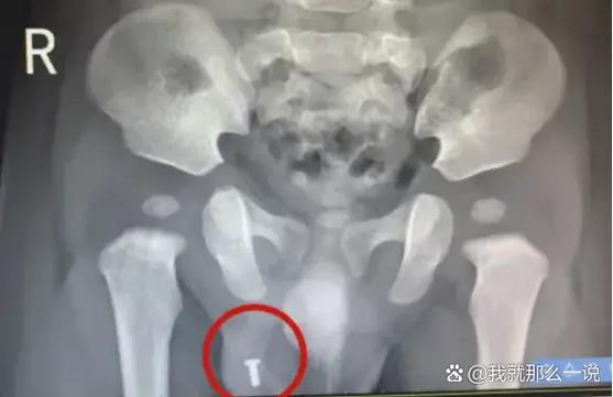 R钉和y钉是哪个部位的