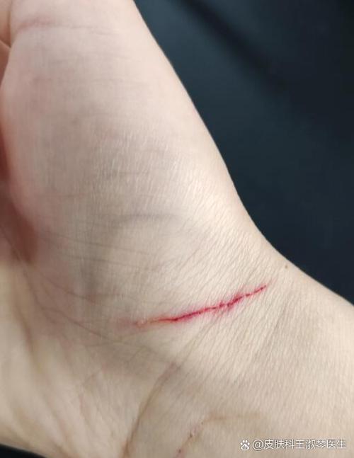 被自家猫抓了一下有道划痕