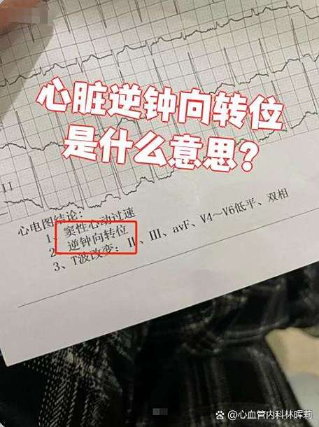 心脏逆钟向转位需要治疗吗