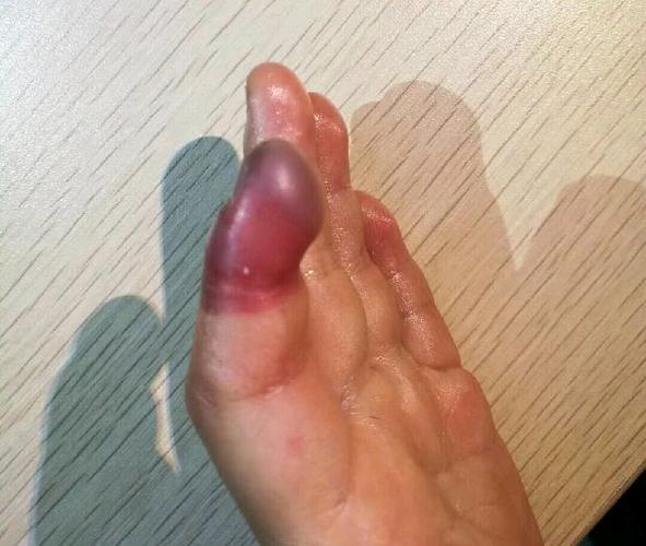 橡皮筋绑手上的危害