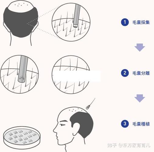 苏州植发正规医院排行