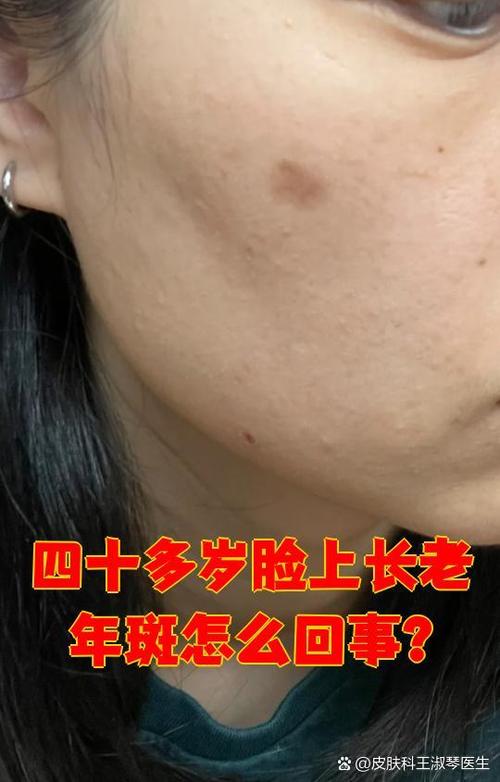 40岁脸上长斑怎么回事