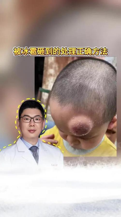 被冰块砸了怎么办