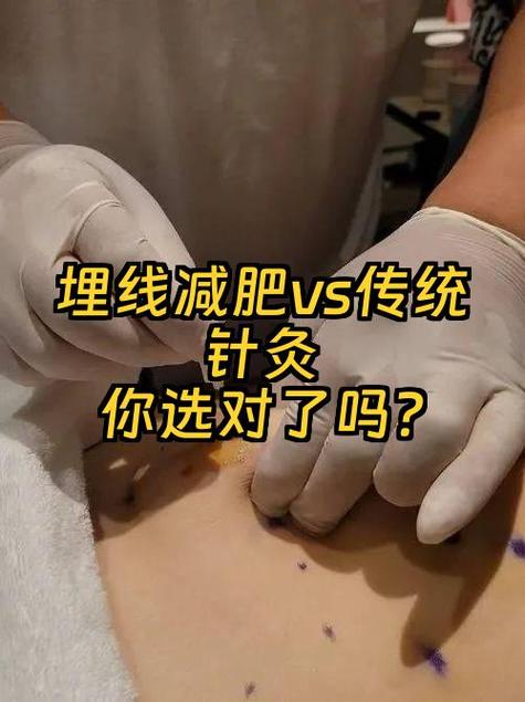 埋线和针灸哪个效果好