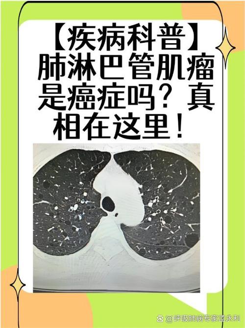 肺上有肿瘤就是癌症吗截图