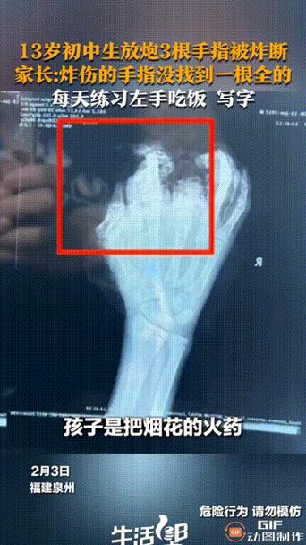 手被炮炸了怎么办