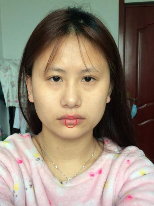 下唇中间有一条线