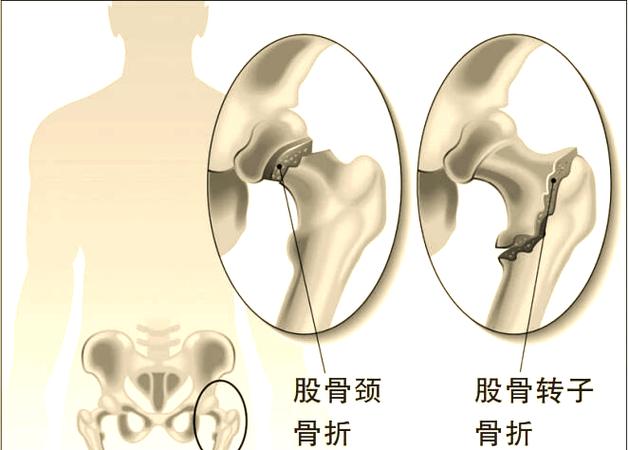 70岁骨折国家最新规定