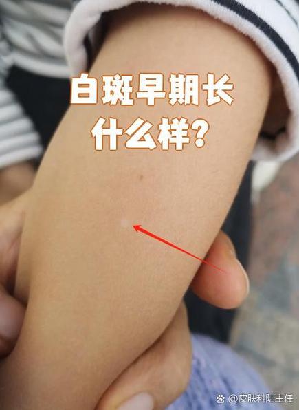 白斑