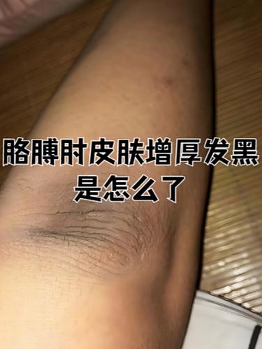 身体肤色变黑是什么原因