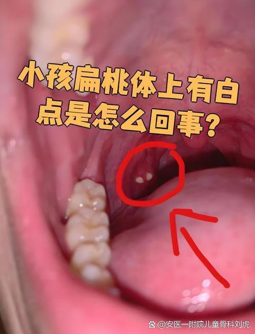 扁桃体发炎的原因