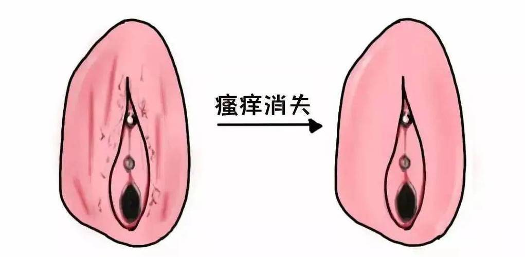 外面阴白斑怎么得的