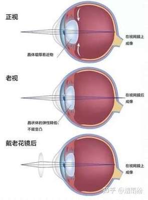 老花镜是什么时候发明的截图