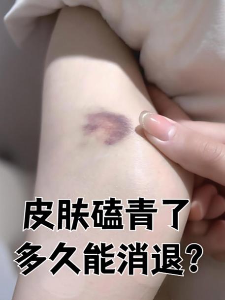 淤青变黄变黄几天能消截图