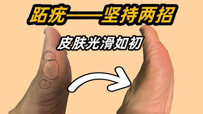 疣是真菌还是病毒