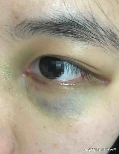 眼睛周围於青了如何快速消