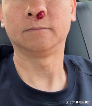 鼻子流鼻血是什么原因游戏截图