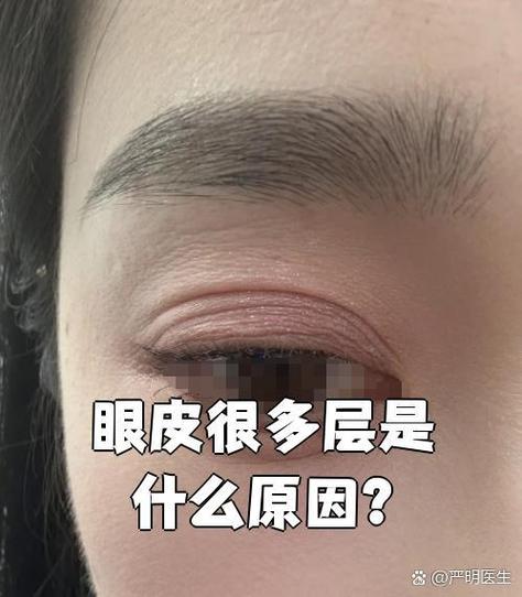 上眼皮多层褶皱怎么办