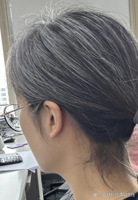 为什么头发越来越白了怎么回事