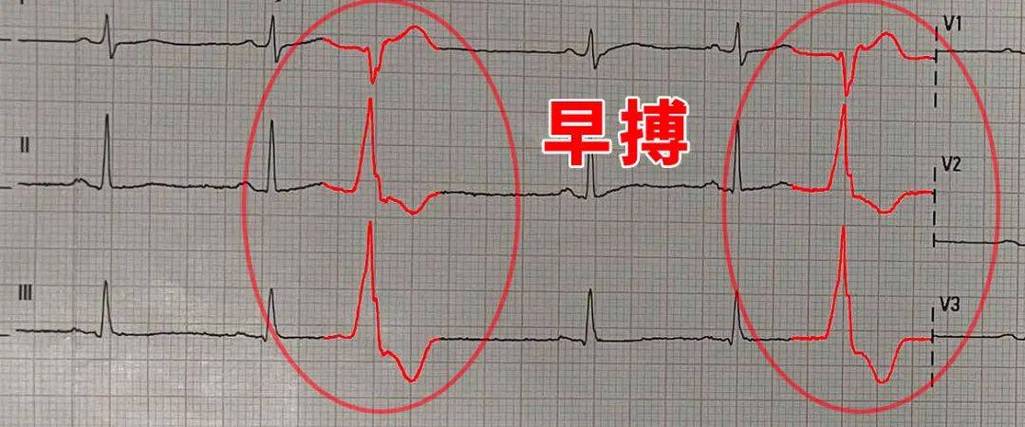 早搏是什么原因