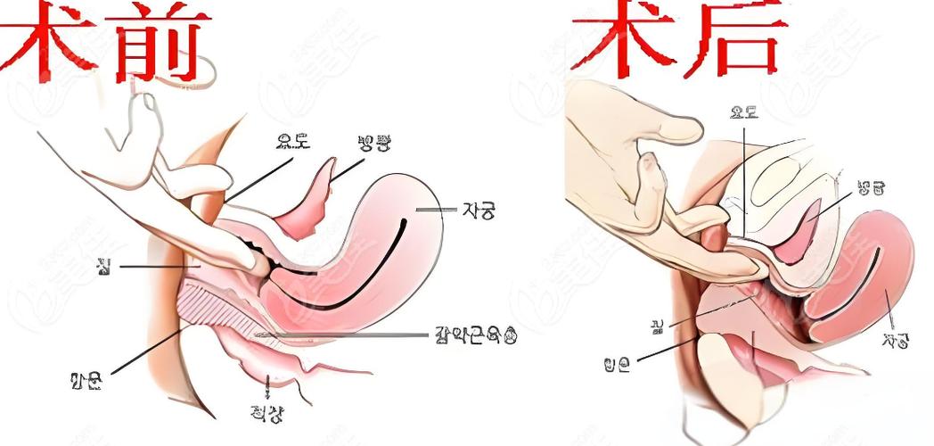 妇科紧缩手术值得做吗