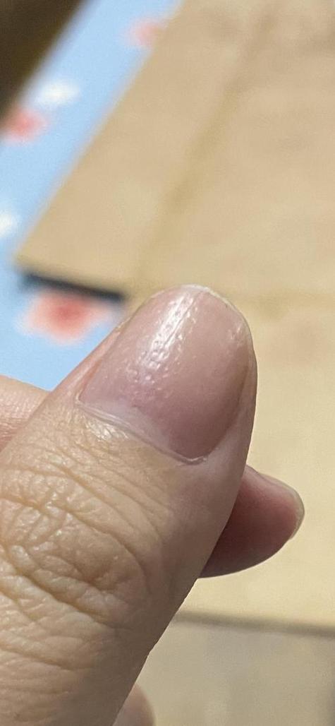 指甲凹凸不平是什么原因