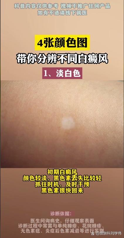 白癜风初期长啥样截图