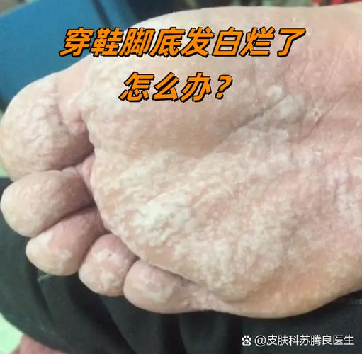 脚被真菌感染
