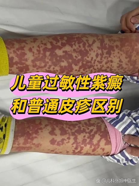 过敏性紫癜的症状截图