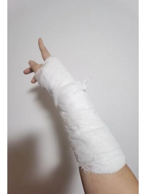 手婉摔骨折了多久可以恢复正常截图