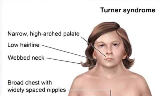 GrαyTurner征名词解释图标