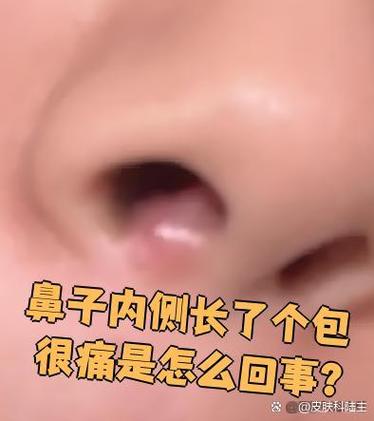 鼻孔入口处长了个包一按就疼