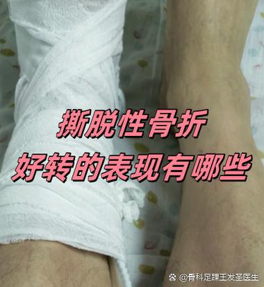 骨折好转的三个迹象图标