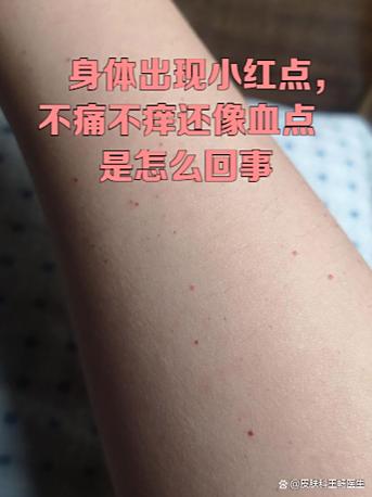 小红点点不疼不痒