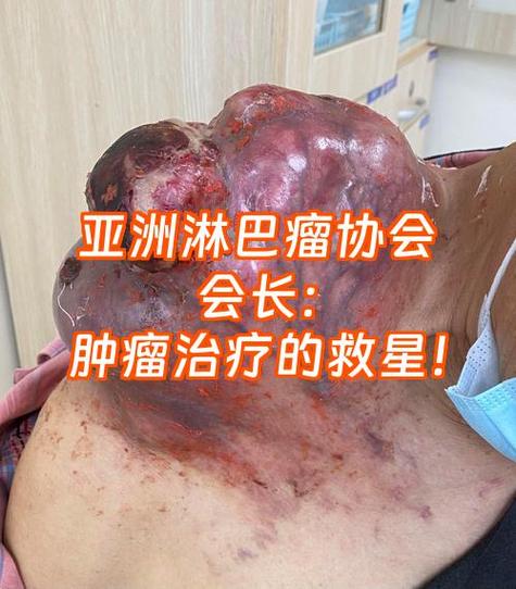 淋巴瘤治疗截图