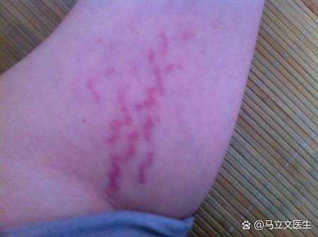 皮肤有紫色斑怎么回事截图