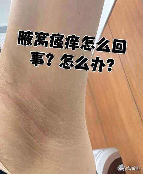 两个腋窝痒是什么原因造成的
