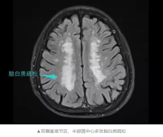 脑白质疏松症一级