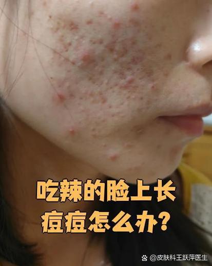 吃辣椒跟长痘痘有关系吗截图