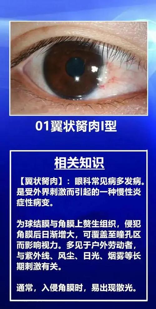 眼睛胬肉严重吗