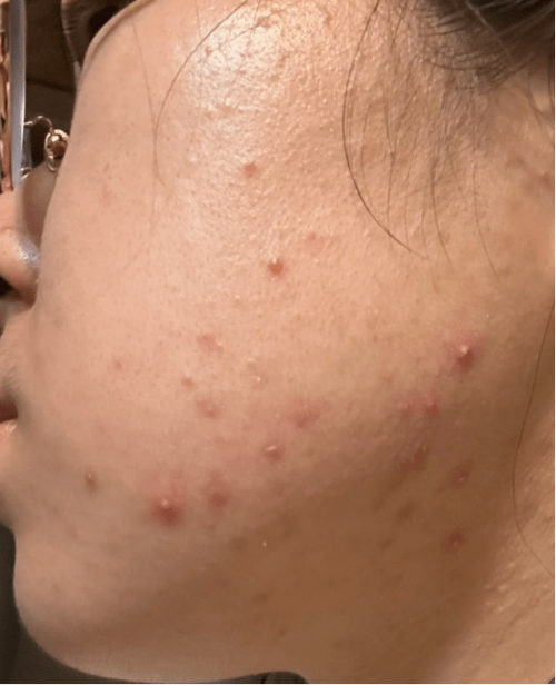 女生说长痘痘了怎么哄缩略图