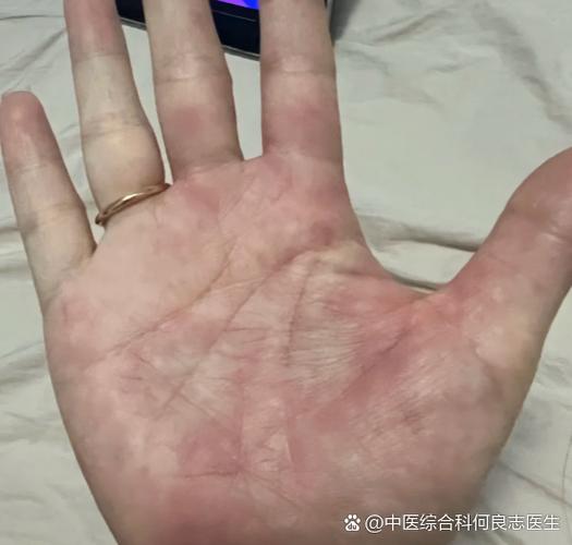 脚掌心痒截图