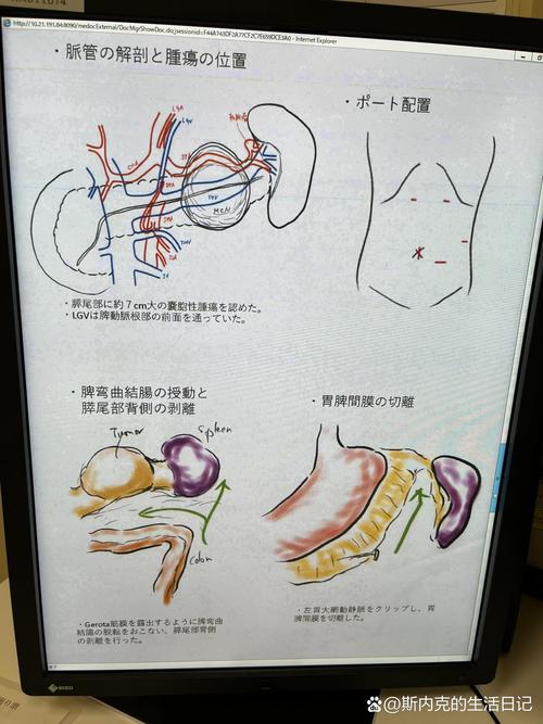 胰腺可以切除吗
