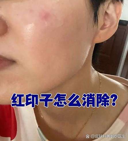 王者印记带红色是什么意思