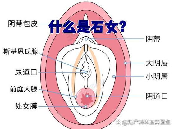 石女是怎么造成的