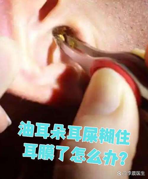 耳机油耳屎怎么清理