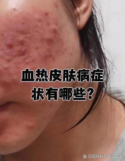 血热皮肤病图片