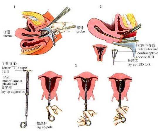 女性可以上手环节育吗